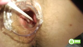 Gory Hairy Pussey Exam: Deep Speculum Thriller